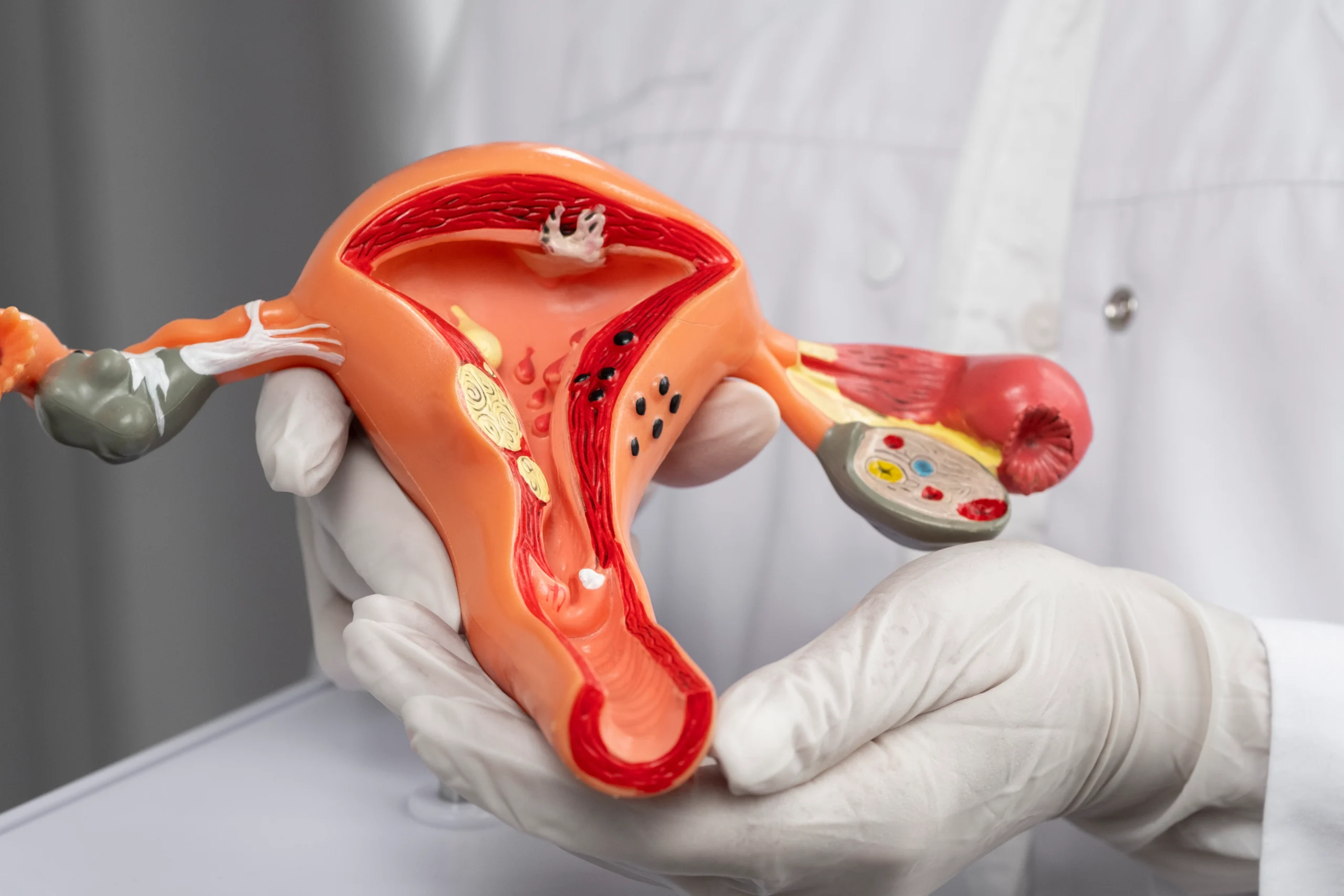 Cystic Ovarian Masses Treatment in Indore, lady gynecologist in indore